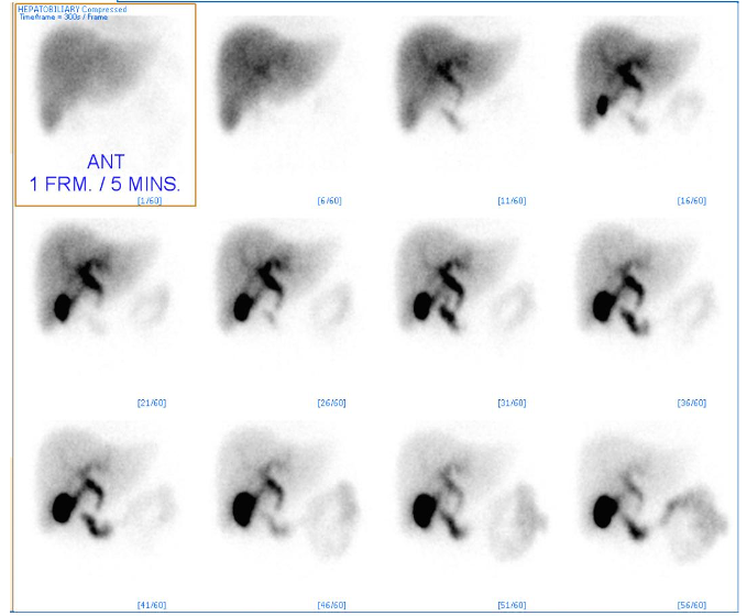 Normal HIDA scan